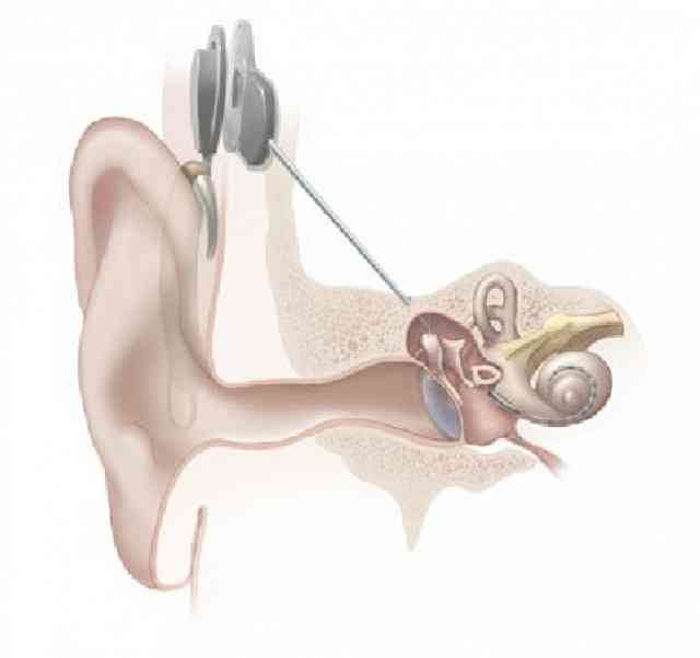Cochlear implant diagram, from the National Institutes of Health